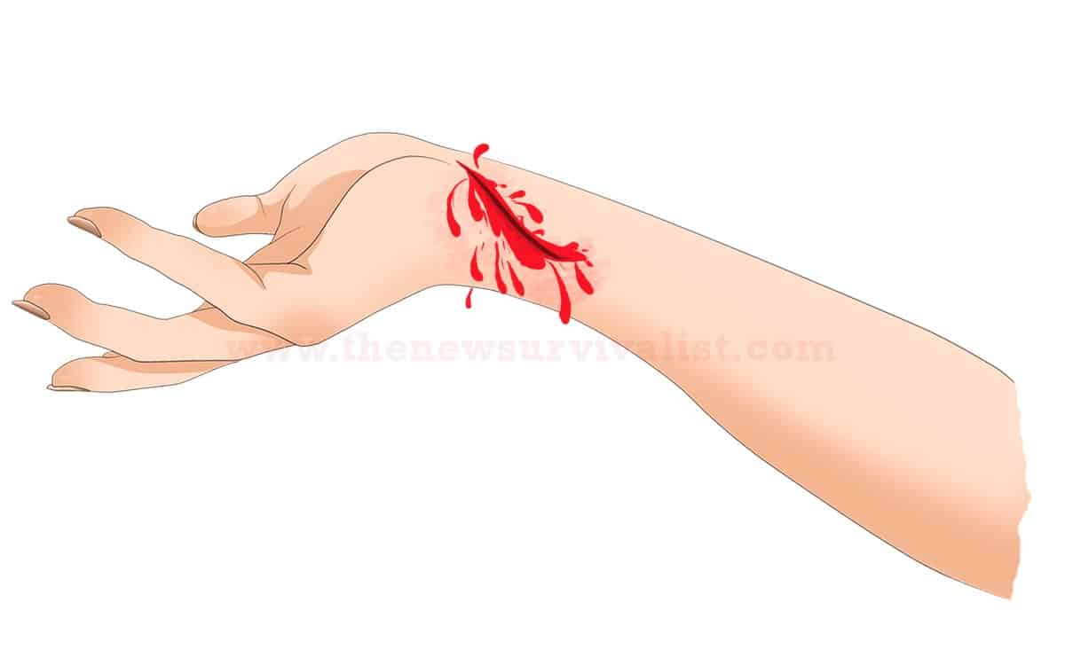 arterial bleeding